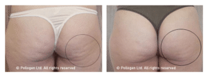 cellulite-4