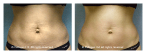 tummy-tightening-1