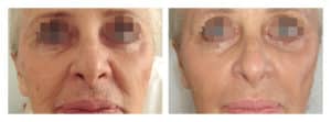voluderm-2