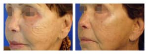 voluderm-5